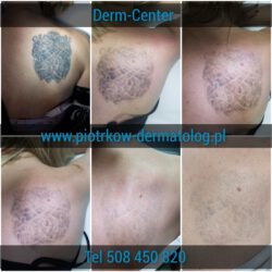 Laserowe usuwanie tatuażu i makijażu permanentnego